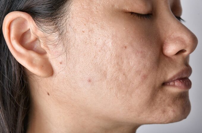 All About Acne Scar Laser Treatments
